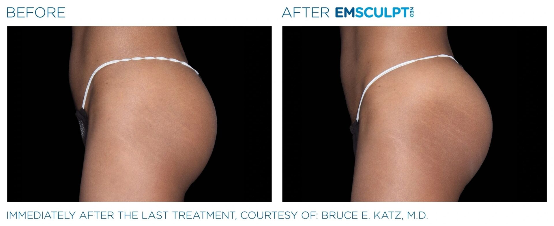 A before and after picture of an emsculpt treatment.