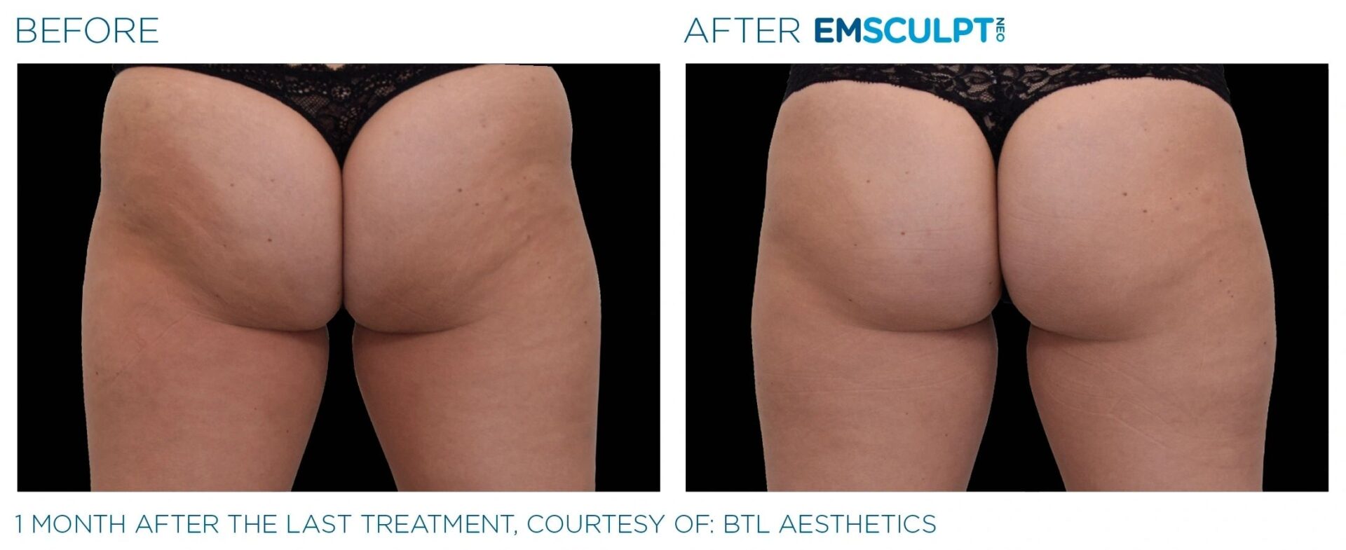 A before and after picture of an emsculpt treatment.